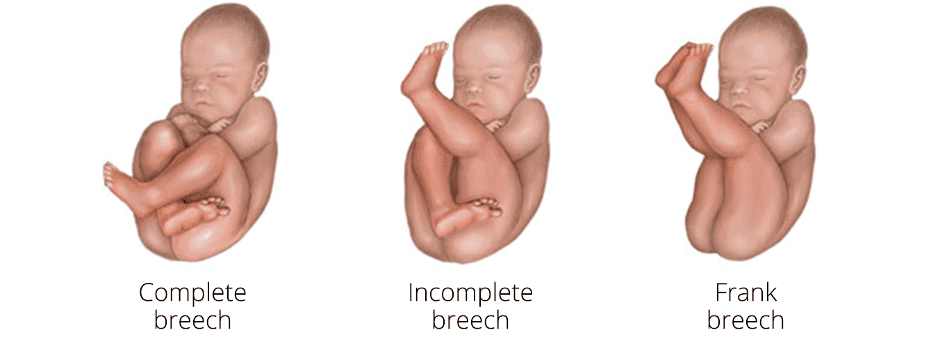 define breech birth presentation
