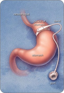 Laparoscopic Adjustable Gastric Banding