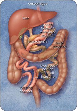 250-biliopancreatic.jpg Biliopancreatic Diversion and Duodenal Switch