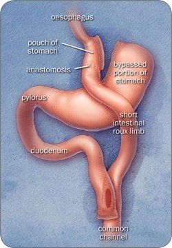 250-bypass.jpg Laparoscopic Roux-en-Y Gastric Bypass