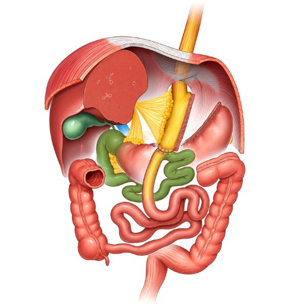 Diagram showing a one anastomosis gastric bypass