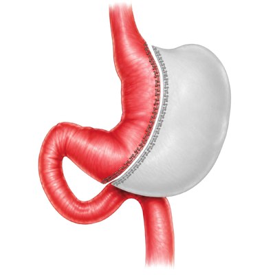 sleeve.jpg Illustration showing sleeve gastrectomy surgery