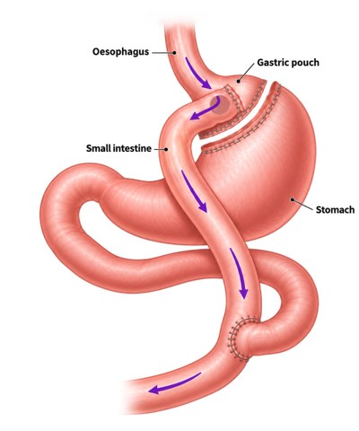 Diagram of gastric bypass surgery showing a small gastric pouch connected to the small intestine, bypassing most of the stomach.