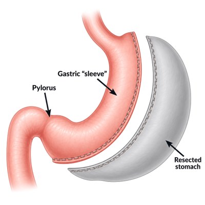 Diagram of sleeve gastrectomy showing the stomach reduced to a narrow gastric sleeve and the removed portion of the stomach
