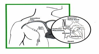CentralLine1.png — Chelsea and Westminster Hospital NHS Foundation Trust