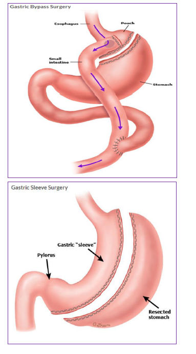 Dietary Guidance after Gastric Bypass or Sleeve Gastrectomy