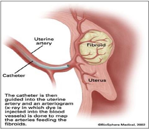 Fibroid — Chelsea and Westminster Hospital NHS Foundation Trust
