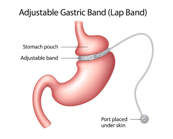 Diagram showing an adjustable gastric band around the upper stomach, creating a small stomach pouch, with tubing connecting the band to a port placed under the skin