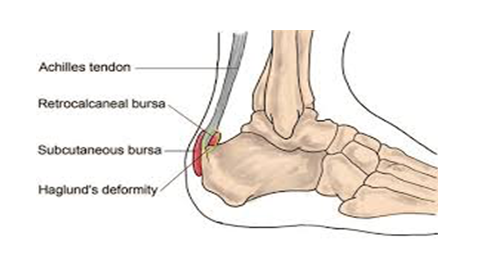 Back Of Heel Pain Back Of Heel Pain
