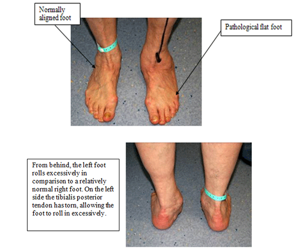 Treating the Flat Foot — Chelsea and Westminster Hospital NHS