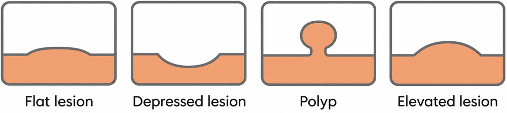 bowel-abnormalities.png Diagram showing four types of bowel lesion: flat lesion, depressed lesion, polyp and elevated lesion.