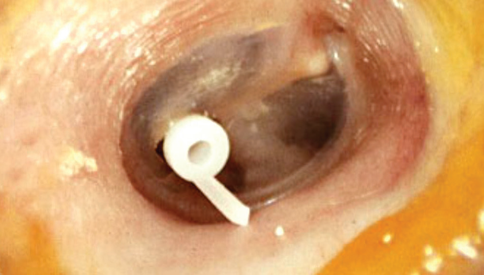 myringotomyandgrommetinsertion.png — Chelsea and Westminster Hospital NHS Foundation Trust