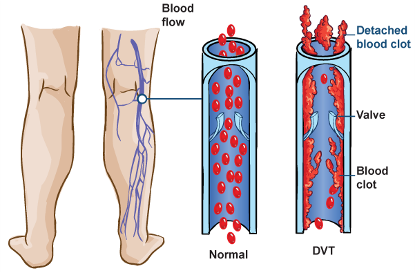 Dvt Vision DVTpic1.png — Chelsea and Westminster Hospital NHS Foundation Trust