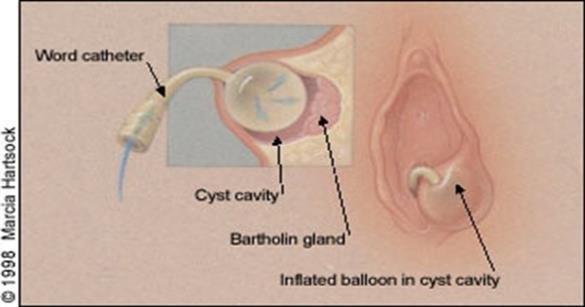 Word catheter for Bartholin's abscess — Chelsea and Westminster Hospital  NHS Foundation Trust